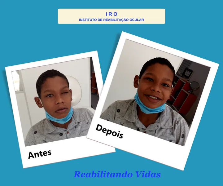 Antes e depois de reabilitação com prótese ocular na IRO