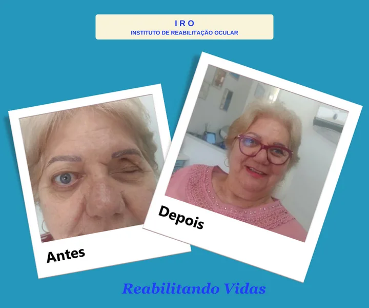 Antes e depois de reabilitação com prótese ocular na IRO