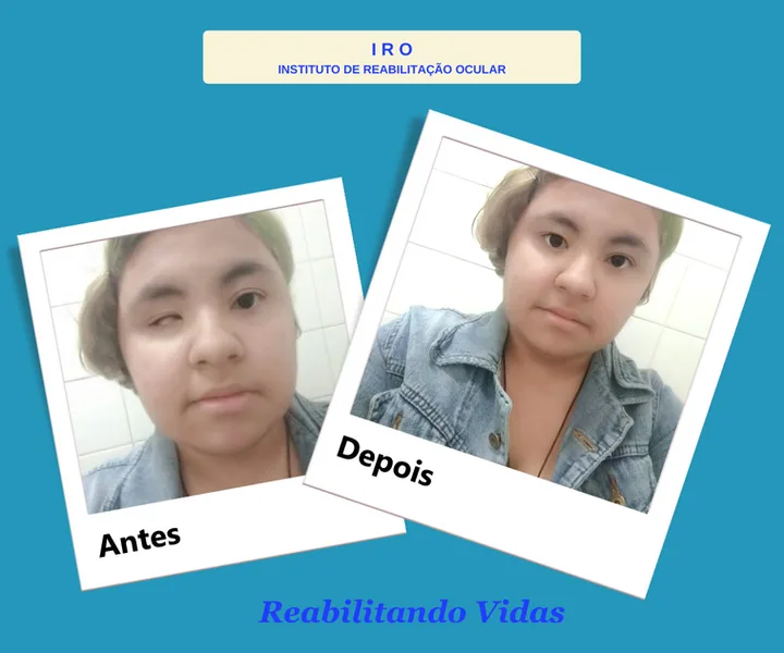Antes e depois de reabilitação com prótese ocular na IRO