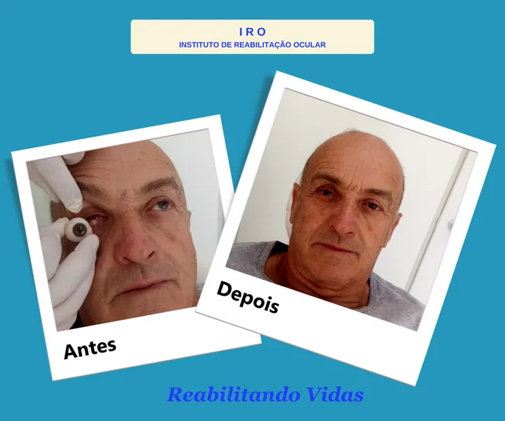 Antes e depois de reabilitação com prótese ocular na IRO
