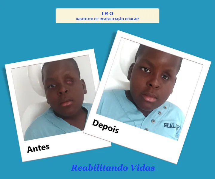 Antes e depois de reabilitação com prótese ocular na IRO