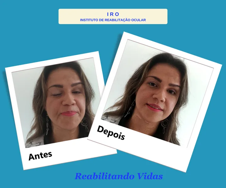 Antes e depois de reabilitação com prótese ocular na IRO