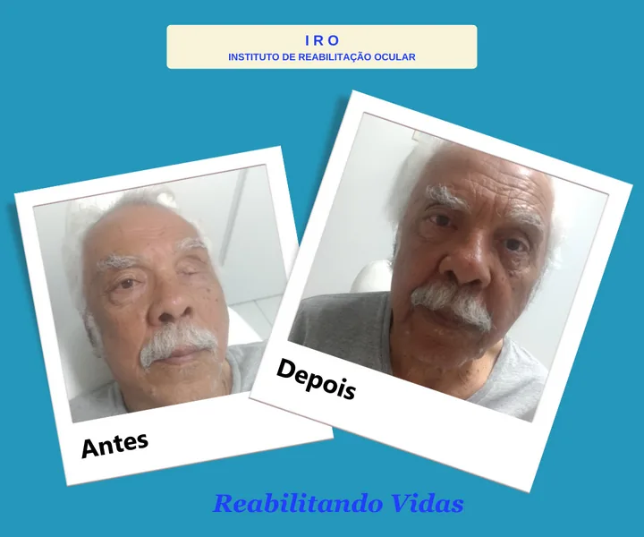 Antes e depois de reabilitação com prótese ocular na IRO