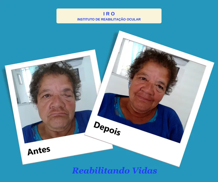 Antes e depois de reabilitação com prótese ocular na IRO