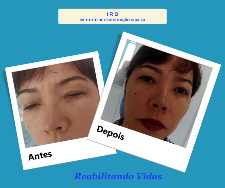 Antes e depois de reabilitação com prótese ocular na IRO