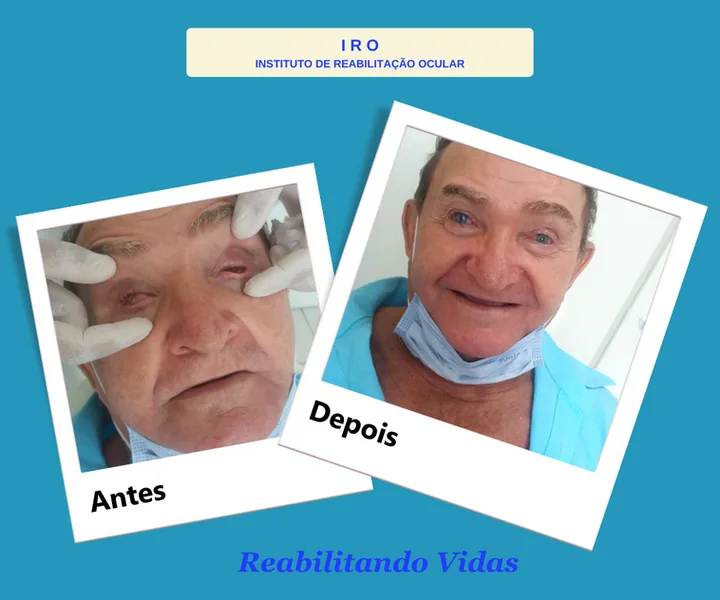 Antes e depois de reabilitação com prótese ocular na IRO