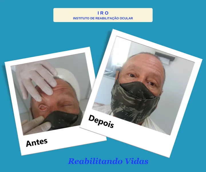 Antes e depois de reabilitação com prótese ocular na IRO