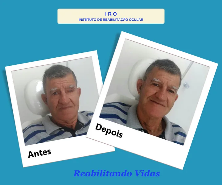 Antes e depois de reabilitação com prótese ocular na IRO