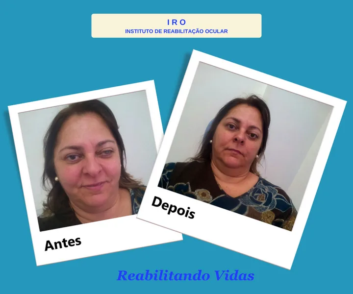 Antes e depois de reabilitação com prótese ocular na IRO
