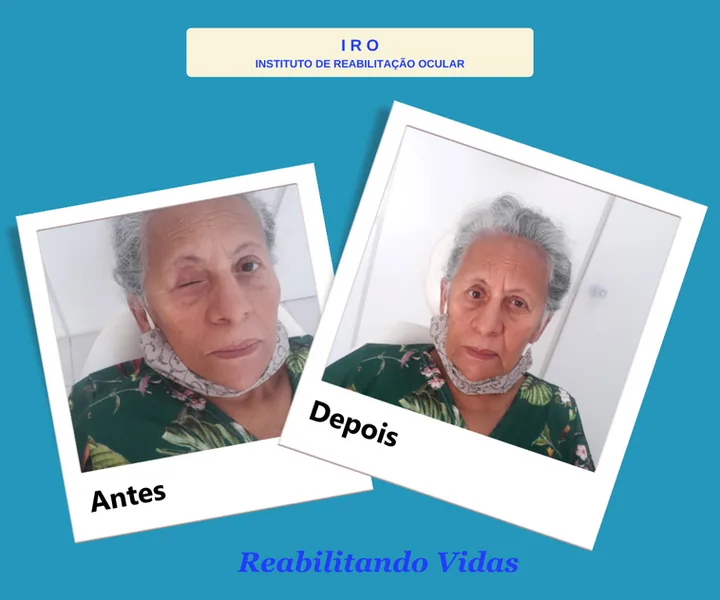Antes e depois de reabilitação com prótese ocular na IRO