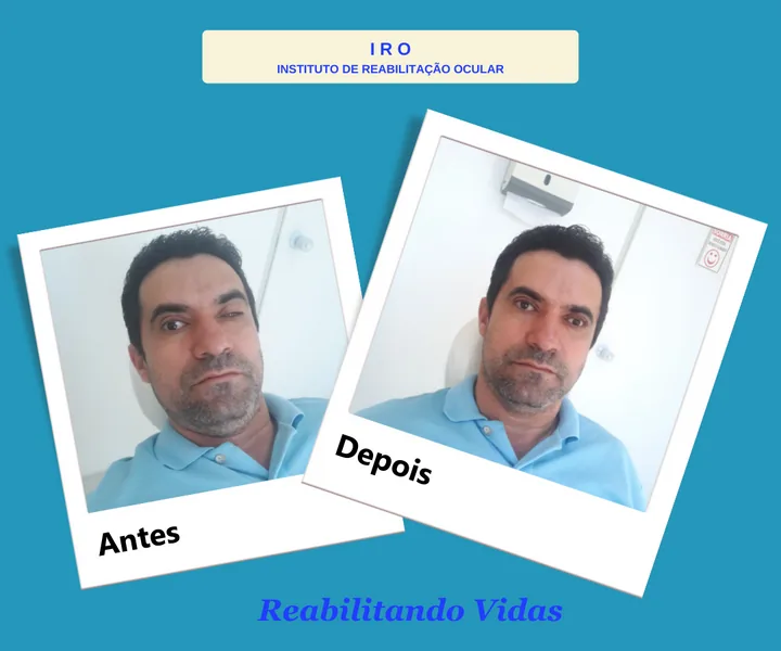Antes e depois de reabilitação com prótese ocular na IRO