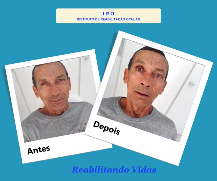 Antes e depois de reabilitação com prótese ocular na IRO