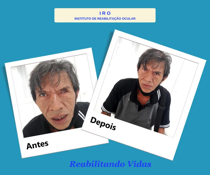 Antes e depois de reabilitação com prótese ocular na IRO