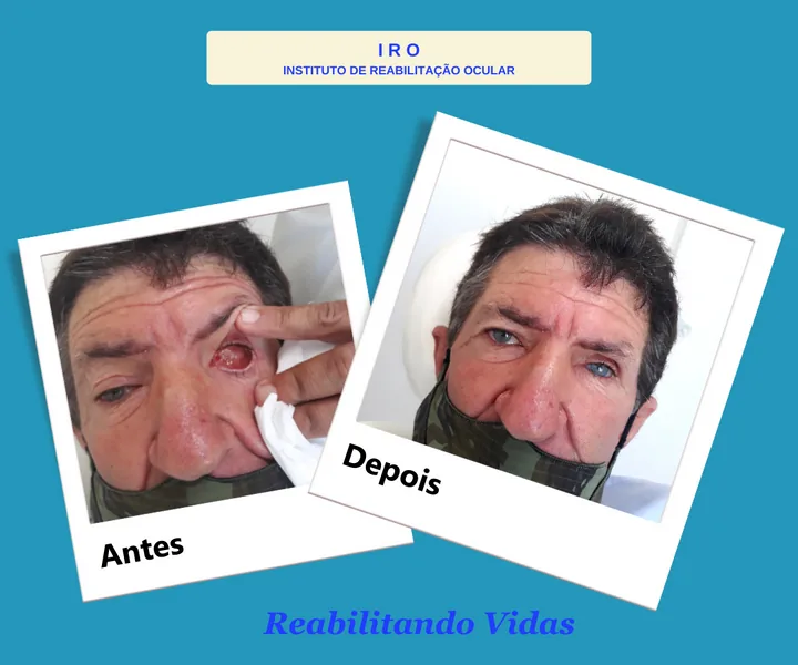 Antes e depois de reabilitação com prótese ocular na IRO
