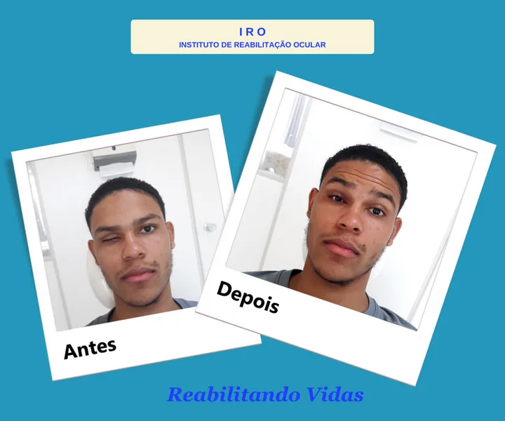 Antes e depois de reabilitação com prótese ocular na IRO