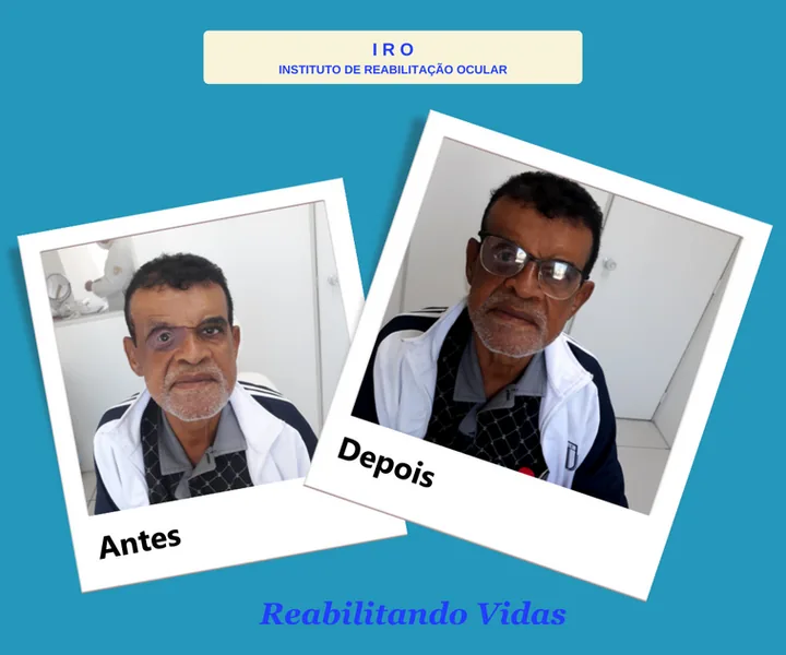 Antes e depois de reabilitação com prótese ocular na IRO