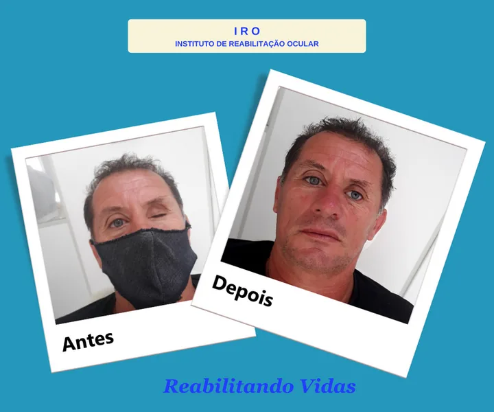 Antes e depois de reabilitação com prótese ocular na IRO