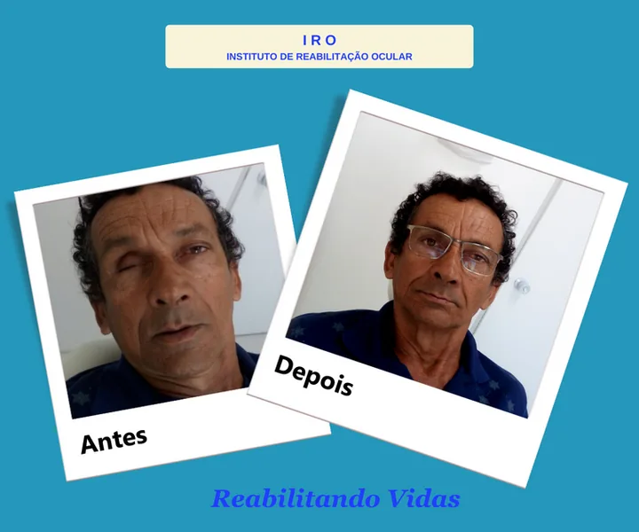 Antes e depois de reabilitação com prótese ocular na IRO