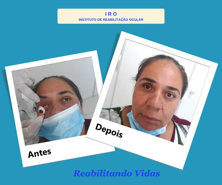 Antes e depois de reabilitação com prótese ocular na IRO