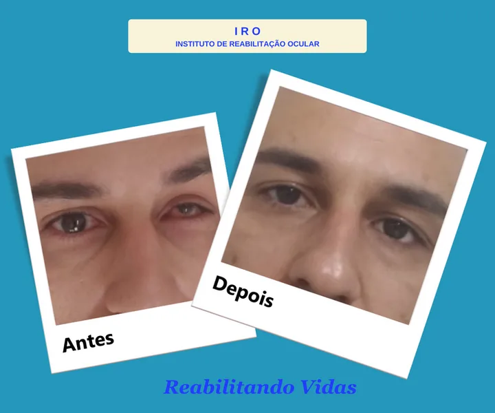 Antes e depois de reabilitação com prótese ocular na IRO